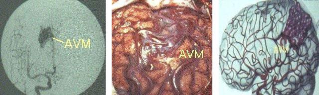 arterio-veneuze malformatie (AVM)