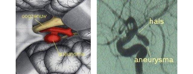 aneurysma