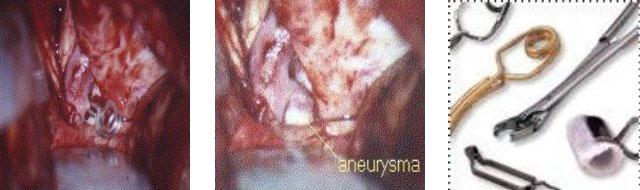 Directe aneurysma afsluiting