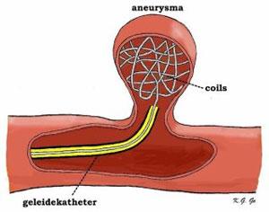 Endovasculaire behandeling - coiling