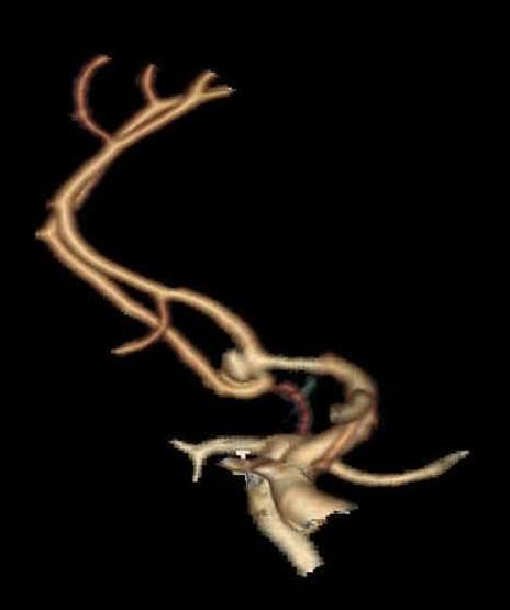aneurisma