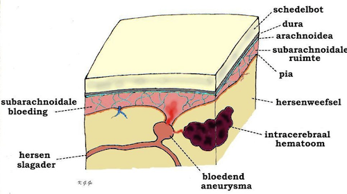 Intracerebrale bloeding situatie