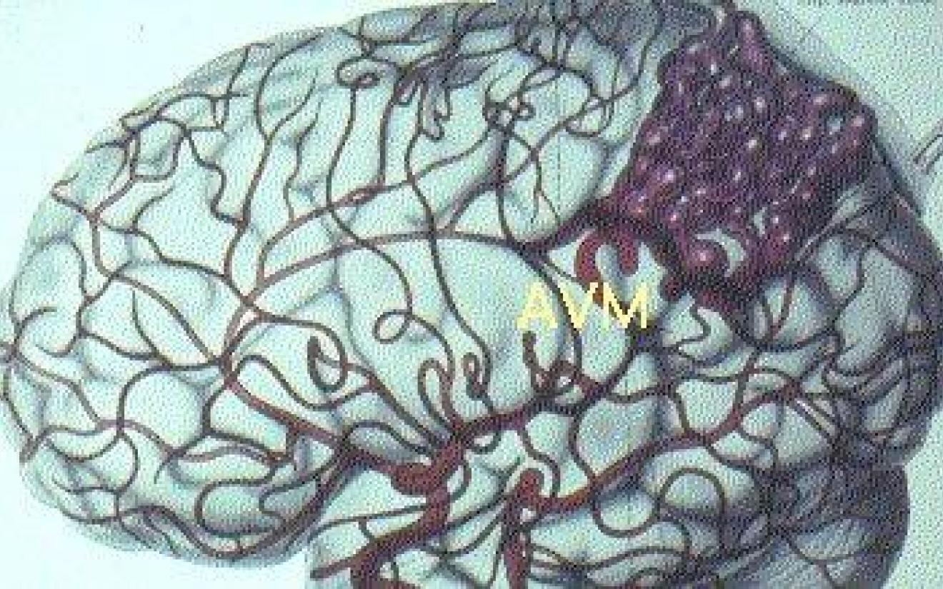 Intracerebrale bloeding