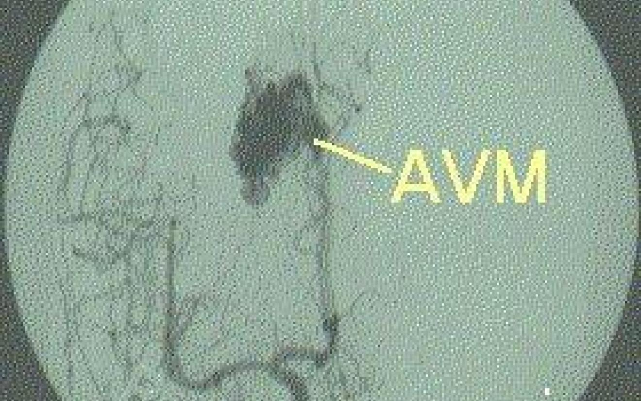 Intracerebrale bloeding AVM