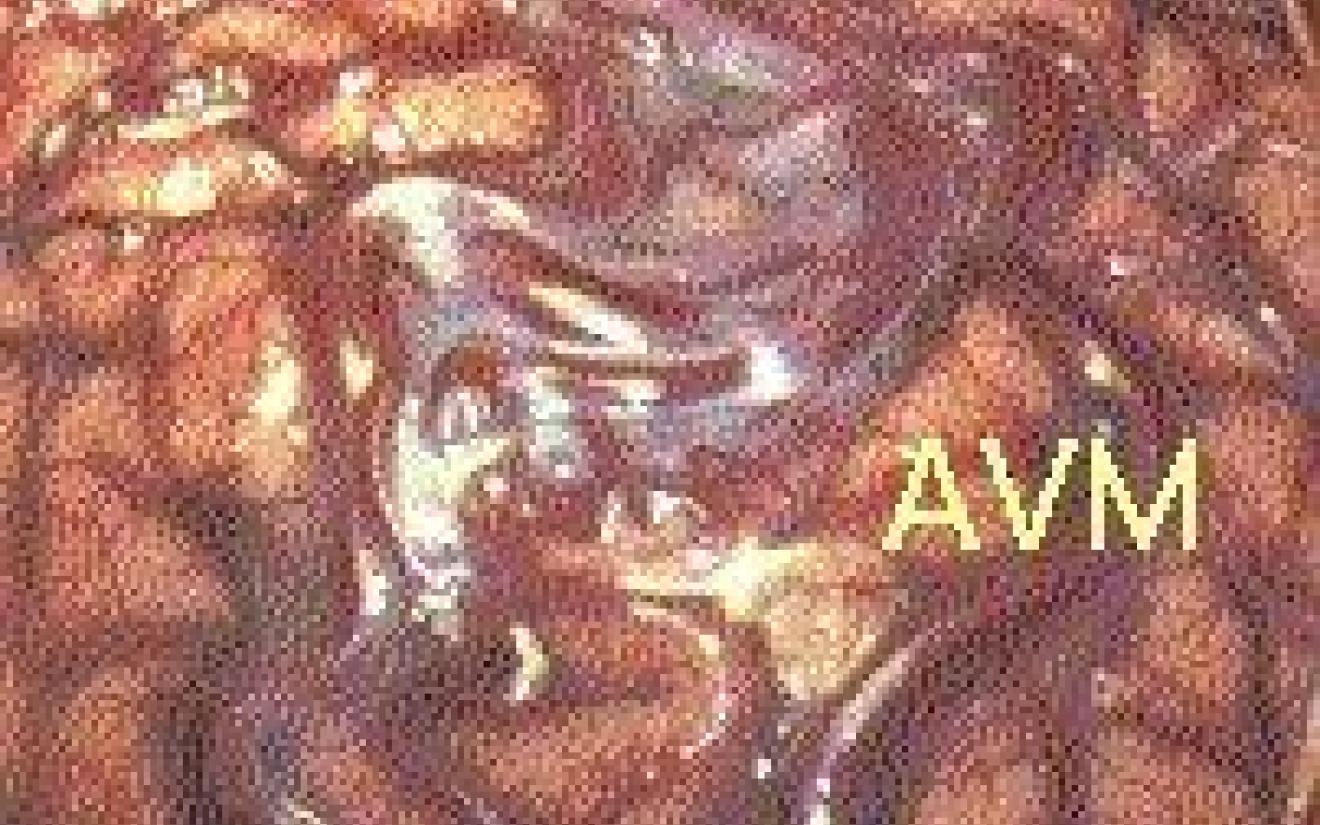Intracerebrale bloeding AVM